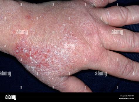 Skin Rash Of Eczema On The Hands Of A 52 Year Old Female Stock Photo
