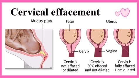 Cervical Effacement Youtube