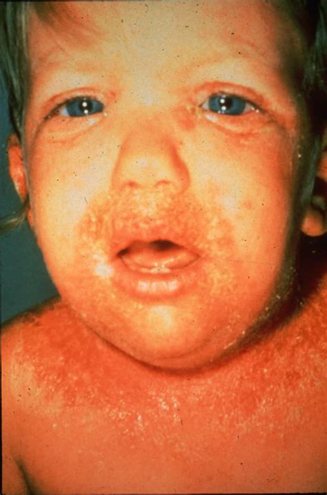 Scalded Skin Syndrome Pictures Pictures Photos
