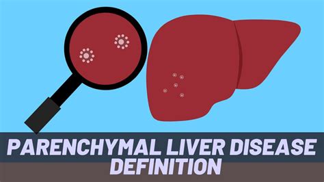 Parenchymal Liver Disease Definition Youtube