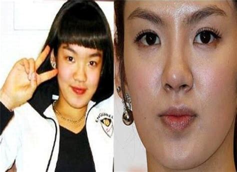 Hyoyeon Snsd Plastic Surgery Nose Job Before And After Celeb Surgery