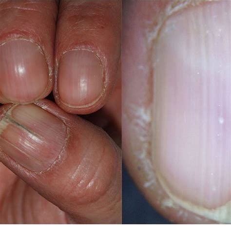 Fingernail Test For Anemia Bios Pics