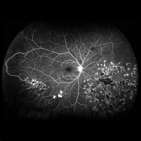 Retinal Laser Treatment Retina Doctor Melbourne
