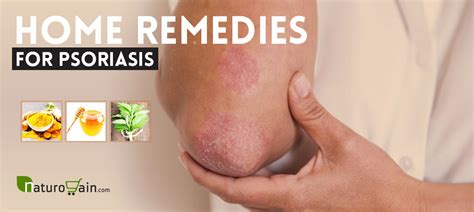 10 Best Home Remedies For Psoriasis That Work Naturally
