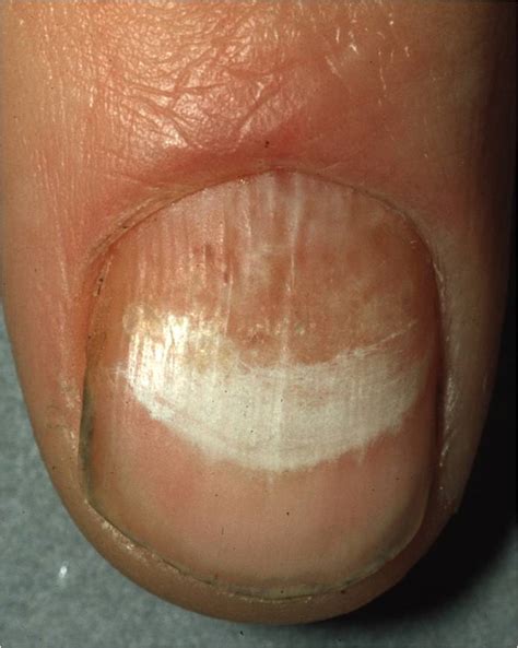 Onychomycosis Tinea Unguium Nail Fungal Infection Dermatology Advisor