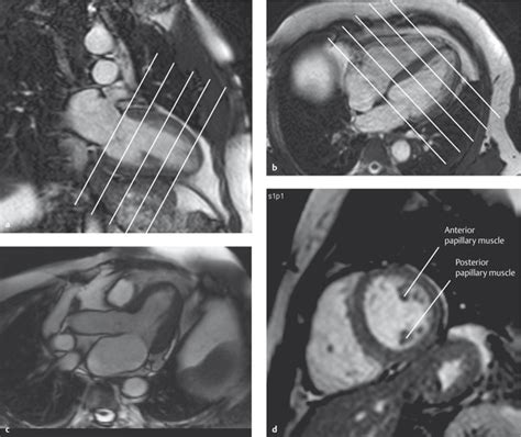 Heart And Pericardium Radiology Key