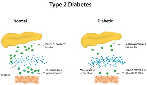 Diagnosed with type 2 diabetes? Type 2 Diabetes: Metabolomics Reveals Lipid Metabolism ...