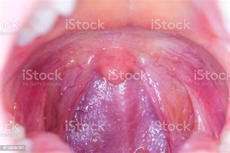 Tonsilitis Infection Throatmacro Opened Mouth Throat Tonsil Stock Photo