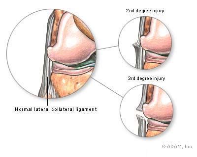 Medial Collateral Ligament Pain Hot Sex Picture