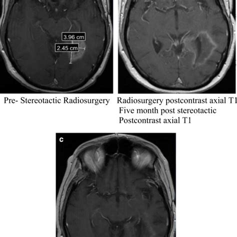 Postcontrast Axial T1 Brain Mri A Pre Stereotactic Radiosurgery B