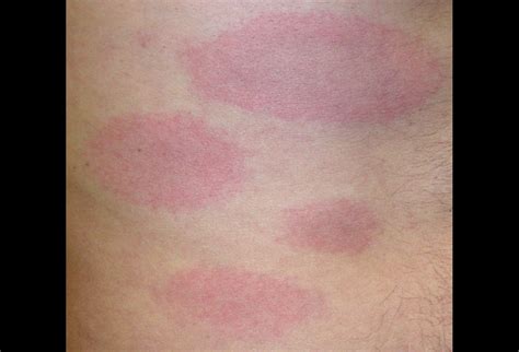 Lyme Disease Early Disseminated Pictures