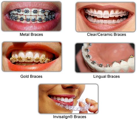 Different Types Different Types Braces
