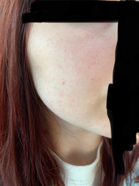 Skin Concern Trying To Fix The Redness And Small Bumps On My Cheeks