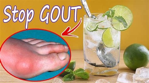 Gout Treatment How To Cure Gout Naturally At Home With Lemon Best
