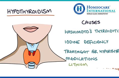 Can Hyperthyroidism Be Cured With Homeopathy Homeocare International