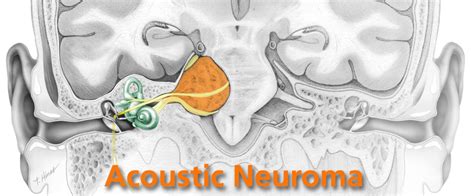 What Are The Best Treatments For Acoustic Neuroma Health Cautions