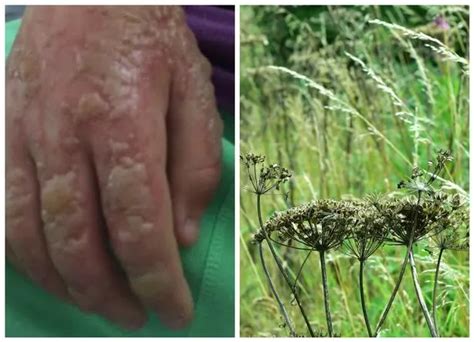 Warning As Recent Heatwave Sparks Giant Hogweed Surge North Wales Live