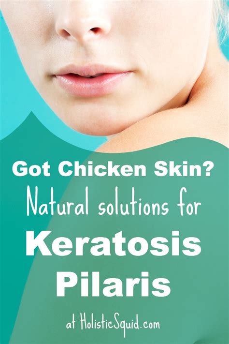 Natural Remedies For Keratosis Pilaris Holistic Squid