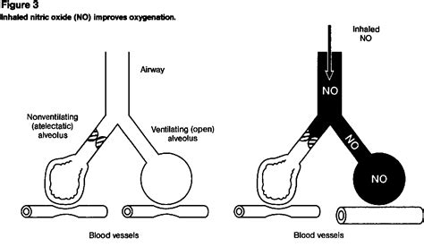 Figure 3 From Inhaled Nitric Oxide As A Selective Pulmonary Vasodilator