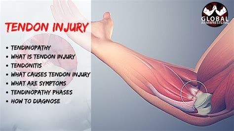 Video Tendinopathy Tendon Injury • Armwrestling • Armwrestling News