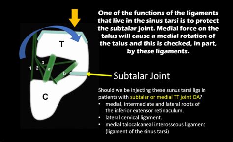Living With A Subtalar Fusion Do You Really Need Surgery Regenexx
