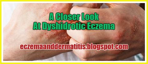 A Closer Look At Dyshidrotic Eczema Eczema And Dermatitis