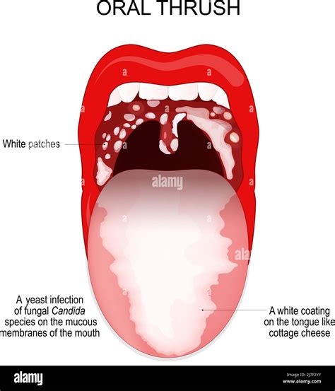 Fungal Infection On Tongue