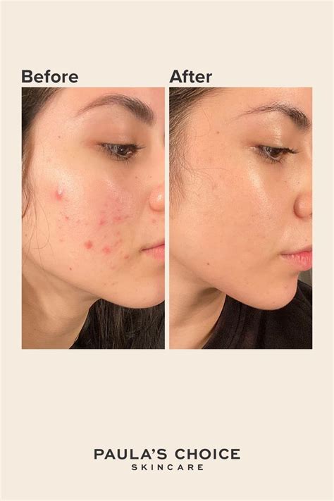 Skin Care Before And After Skin Care Uneven Skin Uneven Skin Tone
