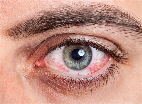 Eye Allergy Allergic Conjunctivitis Allergies And Health