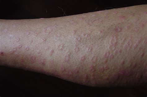 Red Rash On Legs