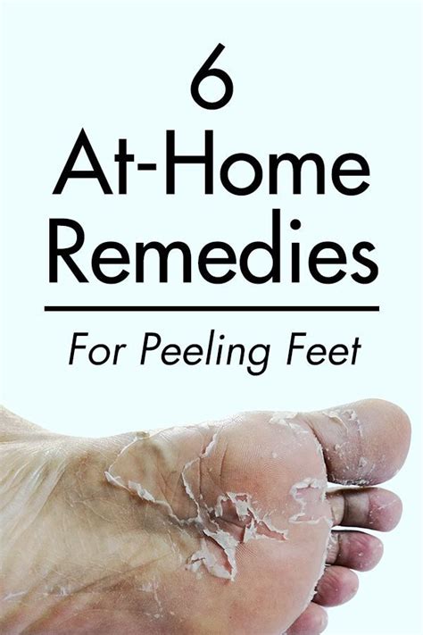 6 At Home Remedies For Peeling Feet Dry Feet Remedies Cracked Feet Remedies Dry Skin Home