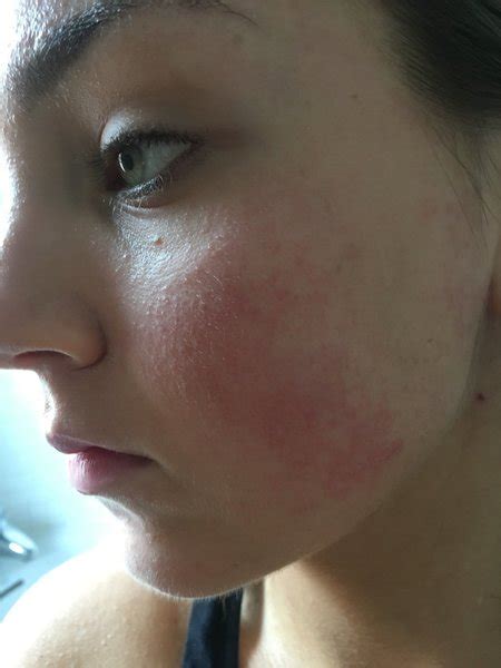 Makeup Allergic Reaction Beautylish