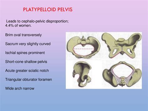 Abnormalities Of Bony Pelvis презентация онлайн