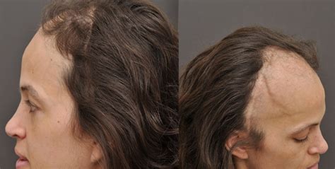 Hair Restoration In A Female Patient Post Craniotomy And Radiation