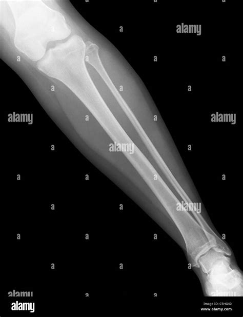 Normal Lower Leg X Ray Stock Photo Alamy