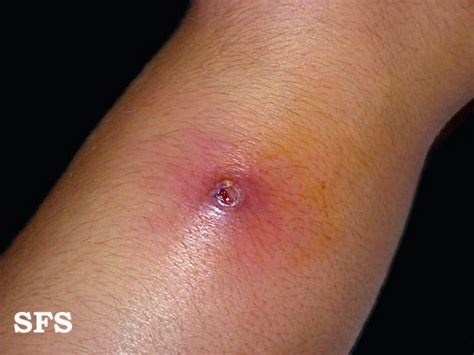 Impetigo Skin Infection Causes Pictures Treatment