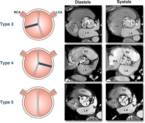 Association Between Bicuspid Aortic Valve Phenotype And Patterns Of Valvular Dysfunction And