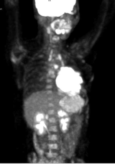 Lymphoma Left Chest Involves The Heart Ctpet Case Studies Ctisus