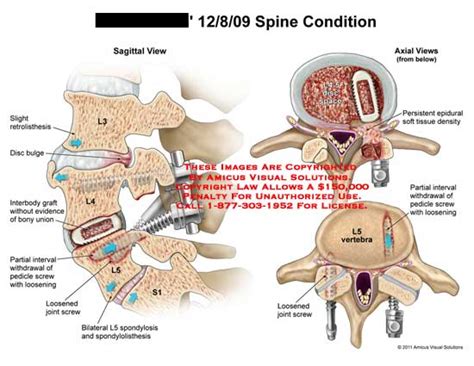 Amicus Illustration Of Amicus Anatomy Spine Condition Retrolisthesis Disc Bulge Interbody Graft