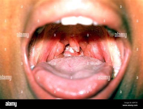 Enlarged Tonsils Stock Photo Alamy