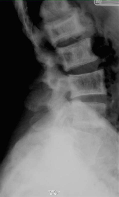 Pagets Disease Of The Lumbar Spine On X Ray X Rays Case Studies