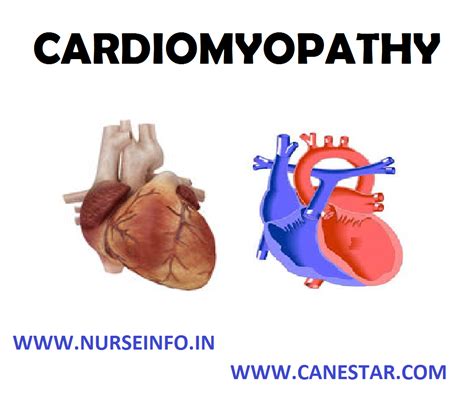 Cardiomyopathy Nurse Info