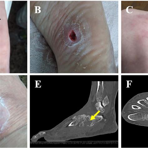 A Plantar Foot Abscess Following A Puncture Injury Before A And After