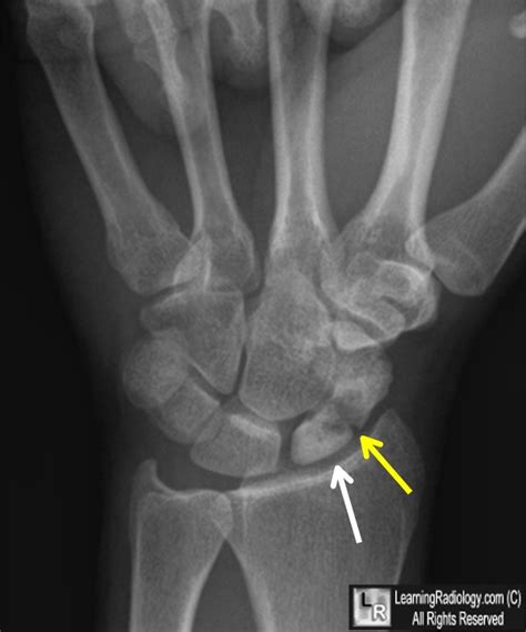 Scaphoid Fracture And Avascular Necrosis Image Radiopaedia Org My XXX