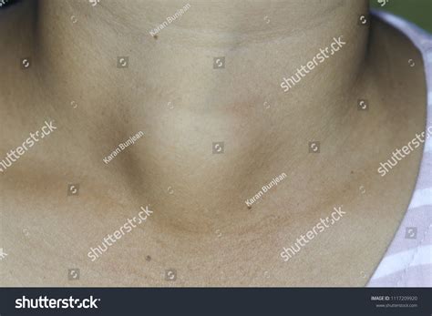 Zooming Closeup Frontal Anterior View Painless Stock Photo 1117209920
