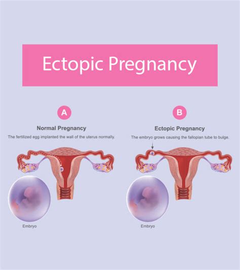 Ectopic Pregnancy Causes Symptoms Treatment And Risks Bút Chì Xanh