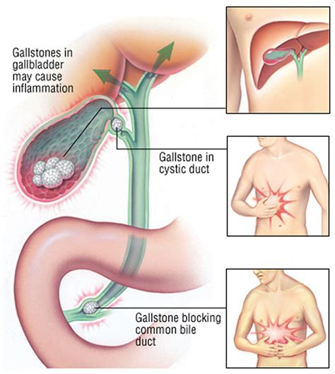 Gallbladder Pain Inflammation Gallstones Cholecystitis Anatomy The