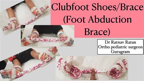 Clubfoot Shoesbraceclubfoot Treatment In Indiagurgaondr Ratnav