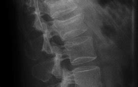 Year Old Man With Back Pain After Falling Stories Journal Of Urgent Care Medicine