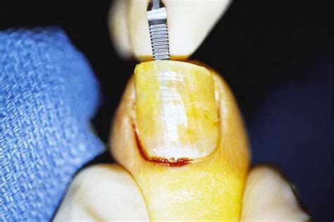 Surgical Pearl Hemostat Assisted Nail Avulsion Revisited Journal Of